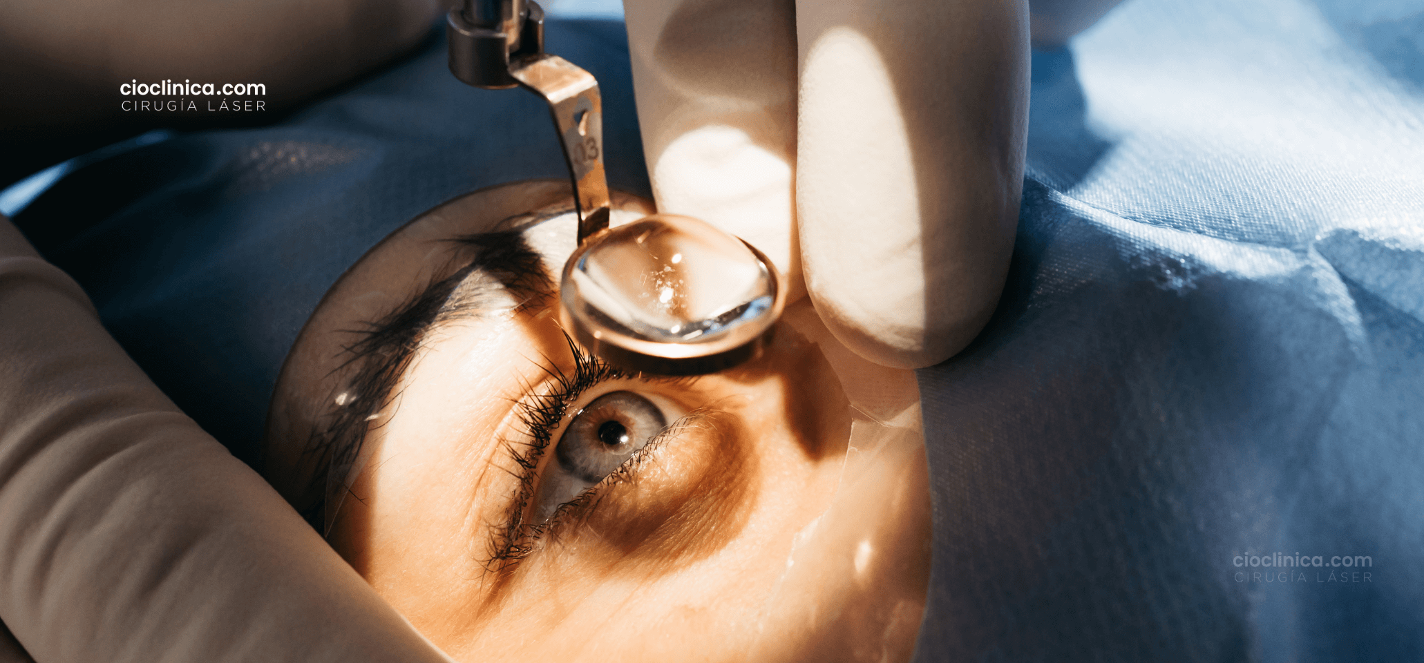 costo-lasik-queretaro