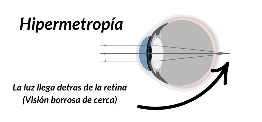 ojo-hipermetrope
