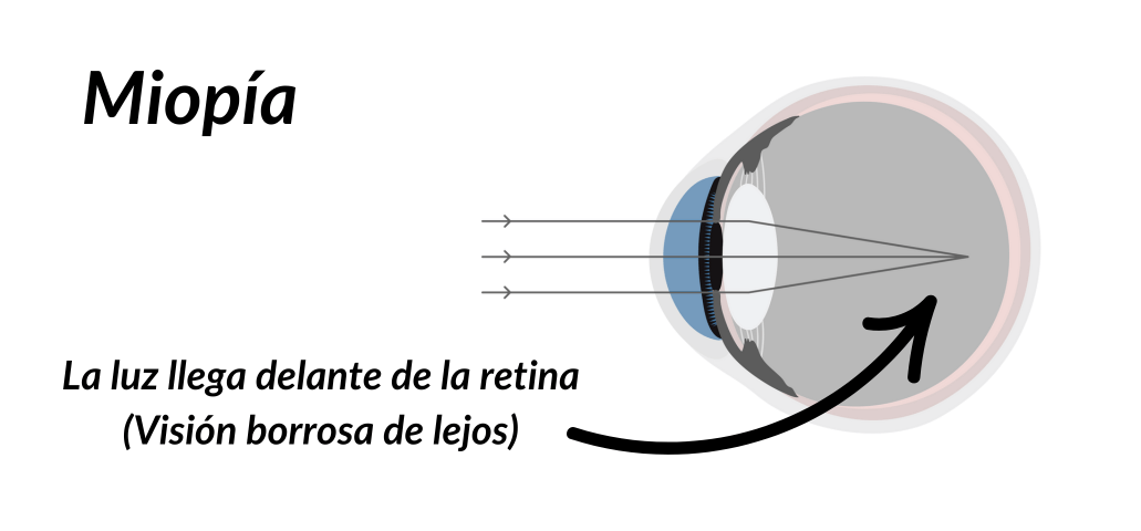 ojo-miope